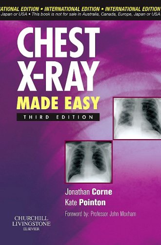 Chest X-Ray Made Easy 