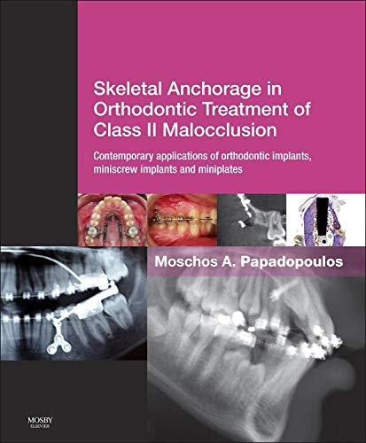 Skeletal Anchorage in Orthodontic Treatment of Class II Malocclusion